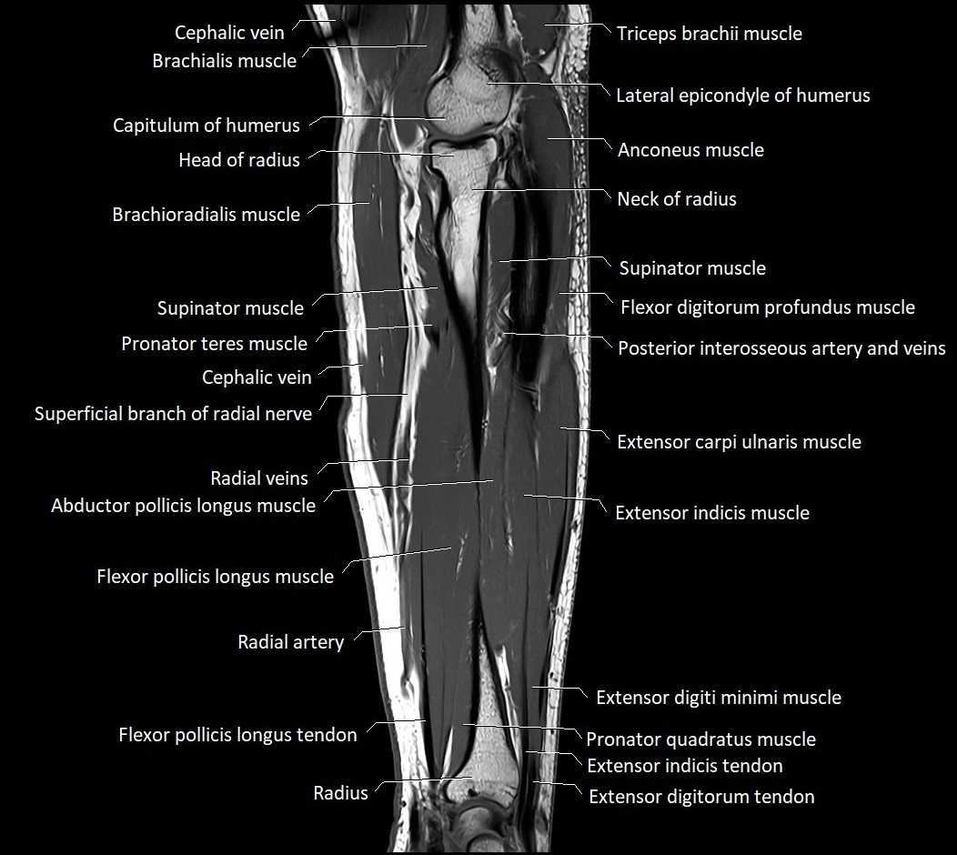 MRI 3T forearm sagittal labelled cross sectional anatomy image 19.webp